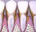 advanced periodontitis