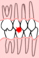 teeth touching too hard