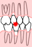gums and bone receding
