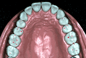 red indicator marks on teeth