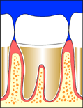 crown cemented in place