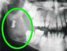 wisdom tooth: cyst