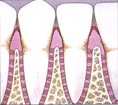 gingivitis