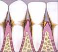 periodontitis