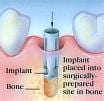dental implant placement