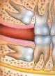 impacted wisdom tooth: horizontal