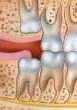 impacted wisdom tooth: vertical