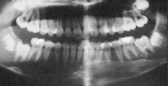panoramic x-ray: wisdom teeth crowding pressure